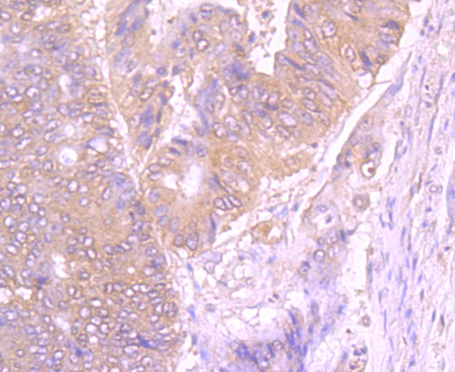 Immunohistochemical analysis of paraffin-embedded human colon cancer tissue using anti-gamma tubulin antibody. Counter stained with hematoxylin.