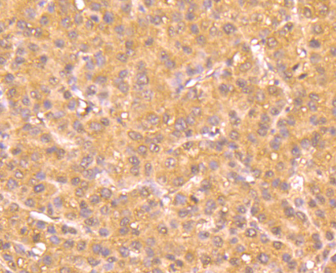 Immunohistochemical analysis of paraffin-embedded human liver carcinoma tissue using anti-Atg12 antibody. The section was pre-treated using heat mediated antigen retrieval with sodium citrate buffer (pH 6.0) for 20 minutes. The tissues were blocked in 5% BSA for 30 minutes at room temperature, washed with ddH2O and PBS, and then probed with the primary antibody (M1701-4, 1/50) for 30 minutes at room temperature. The detection was performed using an HRP conjugated compact polymer system. DAB was used as the chromogen. Tissues were counterstained with hematoxylin and mounted with DPX.