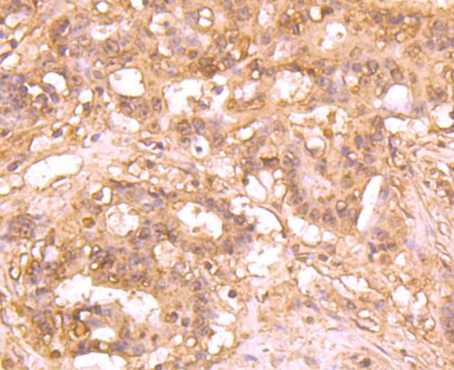 Immunohistochemical analysis of paraffin-embedded human stomach cancer tissue using anti-Atg12 antibody. The section was pre-treated using heat mediated antigen retrieval with sodium citrate buffer (pH 6.0) for 20 minutes. The tissues were blocked in 5% BSA for 30 minutes at room temperature, washed with ddH2O and PBS, and then probed with the primary antibody (M1701-4, 1/50) for 30 minutes at room temperature. The detection was performed using an HRP conjugated compact polymer system. DAB was used as the chromogen. Tissues were counterstained with hematoxylin and mounted with DPX.
