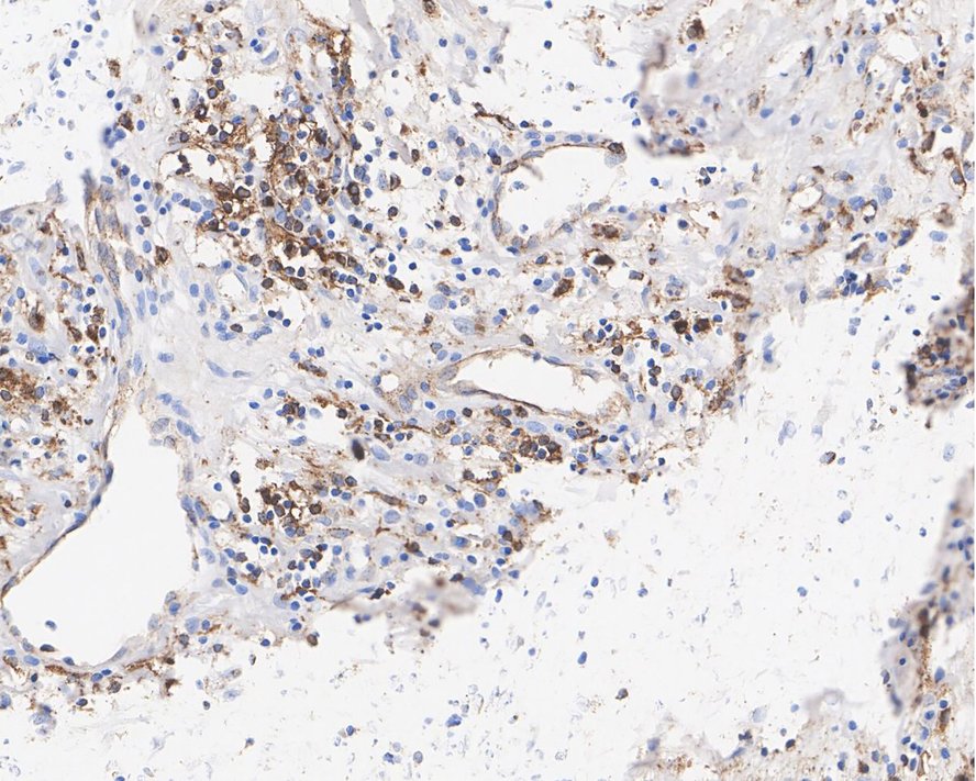 Immunohistochemical analysis of paraffin-embedded human lung cancer tissue with Mouse anti-HLA-DR antibody (M1701-5) at 1/1,000 dilution.<br />
<br />
The section was pre-treated using heat mediated antigen retrieval with Tris-EDTA buffer (pH 9.0) for 20 minutes. The tissues were blocked in 1% BSA for 20 minutes at room temperature, washed with ddH2O and PBS, and then probed with the primary antibody (M1701-5) at 1/1,000 dilution for 1 hour at room temperature. The detection was performed using an HRP conjugated compact polymer system. DAB was used as the chromogen. Tissues were counterstained with hematoxylin and mounted with DPX.