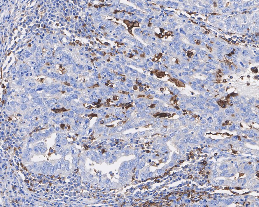 Immunohistochemical analysis of paraffin-embedded human stomach cancer tissue with Mouse anti-HLA-DR antibody (M1701-5) at 1/1,000 dilution.<br />
<br />
The section was pre-treated using heat mediated antigen retrieval with Tris-EDTA buffer (pH 9.0) for 20 minutes. The tissues were blocked in 1% BSA for 20 minutes at room temperature, washed with ddH2O and PBS, and then probed with the primary antibody (M1701-5) at 1/1,000 dilution for 1 hour at room temperature. The detection was performed using an HRP conjugated compact polymer system. DAB was used as the chromogen. Tissues were counterstained with hematoxylin and mounted with DPX.