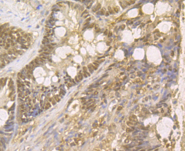 Immunohistochemical analysis of paraffin-embedded human colon cancer tissue using anti-GAPDH antibody. The section was pre-treated using heat mediated antigen retrieval with Tris-EDTA buffer (pH 8.0-8.4) for 20 minutes.The tissues were blocked in 5% BSA for 30 minutes at room temperature, washed with ddH2O and PBS, and then probed with the antibody (R1210-1) at 1/100 dilution, for 30 minutes at room temperature and detected using an HRP conjugated compact polymer system. DAB was used as the chrogen. Counter stained with hematoxylin and mounted with DPX.