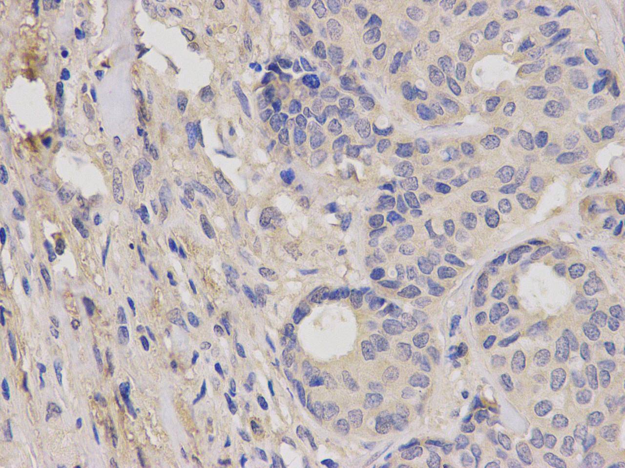 Immunohistochemical analysis of paraffin-embedded human breast carcinoma tissue using anti- IGF1R rabbit polyclonal antibody.