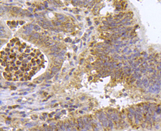 Immunohistochemical analysis of paraffin- embedded human colon carcinoma tissue using anti-HIF-1 alpha rabbit polyclonal antibody.  .