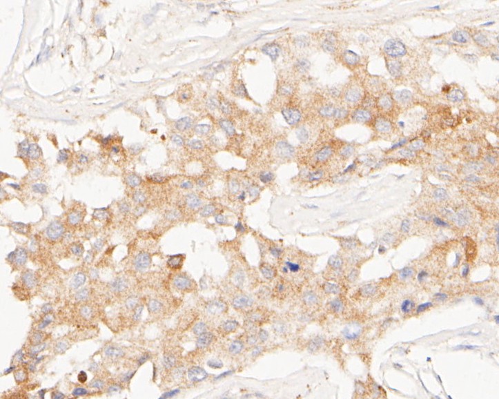 Immunohistochemical analysis of paraffin-embedded human breast cancer tissue using anti-Meckelin antibody. The section was pre-treated using heat mediated antigen retrieval with Tris-EDTA buffer (pH 8.0-8.4) for 20 minutes.The tissues were blocked in 5% BSA for 30 minutes at room temperature, washed with ddH2O and PBS, and then probed with the primary antibody (0903-7, 1/200) for 30 minutes at room temperature. The detection was performed using an HRP conjugated compact polymer system. DAB was used as the chromogen. Tissues were counterstained with hematoxylin and mounted with DPX.
