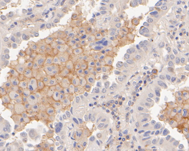 Immunohistochemical analysis of paraffin-embedded human lung cancer tissue using anti-SIRP alpha antibody. The section was pre-treated using heat mediated antigen retrieval with Tris-EDTA buffer (pH 8.0-8.4) for 20 minutes.The tissues were blocked in 5% BSA for 30 minutes at room temperature, washed with ddH2O and PBS, and then probed with the primary antibody (EM1902-37, 1/100) for 30 minutes at room temperature. The detection was performed using an HRP conjugated compact polymer system. DAB was used as the chromogen. Tissues were counterstained with hematoxylin and mounted with DPX.
