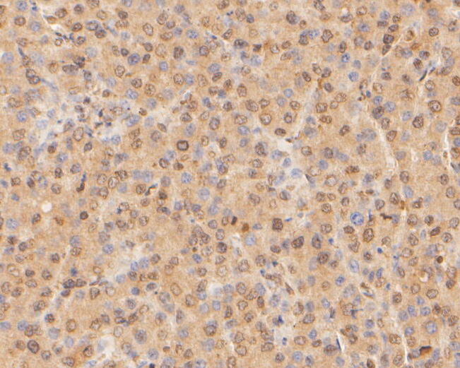 Immunohistochemical analysis of paraffin-embedded human liver cancer tissue using anti-CPEB1 antibody. The section was pre-treated using heat mediated antigen retrieval with sodium citrate buffer (pH 6.0) for 20 minutes. The tissues were blocked in 5% BSA for 30 minutes at room temperature, washed with ddH2O and PBS, and then probed with the primary antibody (ER1902-89, 1100)  for 30 minutes at room temperature. The detection was performed using an HRP conjugated compact polymer system. DAB was used as the chromogen. Tissues were counterstained with hematoxylin and mounted with DPX.