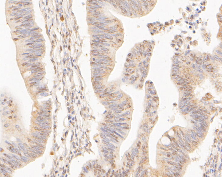 Immunohistochemical analysis of paraffin-embedded human colon cancer tissue using anti-CPEB1 antibody. The section was pre-treated using heat mediated antigen retrieval with sodium citrate buffer (pH 6.0) for 20 minutes. The tissues were blocked in 5% BSA for 30 minutes at room temperature, washed with ddH2O and PBS, and then probed with the primary antibody (ER1902-89, 1/400)  for 30 minutes at room temperature. The detection was performed using an HRP conjugated compact polymer system. DAB was used as the chromogen. Tissues were counterstained with hematoxylin and mounted with DPX.