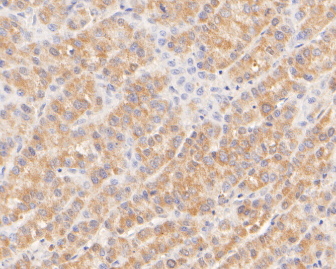 Immunohistochemical analysis of paraffin-embedded human liver cancer tissue using anti-CPEB1 antibody. The section was pre-treated using heat mediated antigen retrieval with sodium citrate buffer (pH 6.0) for 20 minutes. The tissues were blocked in 5% BSA for 30 minutes at room temperature, washed with ddH2O and PBS, and then probed with the primary antibody (ER1902-92, 1/400)  for 30 minutes at room temperature. The detection was performed using an HRP conjugated compact polymer system. DAB was used as the chromogen. Tissues were counterstained with hematoxylin and mounted with DPX.