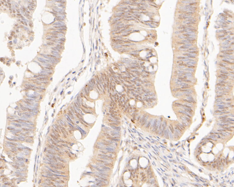Immunohistochemical analysis of paraffin-embedded human colon cancer tissue using anti-CPEB1 antibody. The section was pre-treated using heat mediated antigen retrieval with sodium citrate buffer (pH 6.0) for 20 minutes. The tissues were blocked in 5% BSA for 30 minutes at room temperature, washed with ddH2O and PBS, and then probed with the primary antibody (ER1902-92, 1/400)  for 30 minutes at room temperature. The detection was performed using an HRP conjugated compact polymer system. DAB was used as the chromogen. Tissues were counterstained with hematoxylin and mounted with DPX.