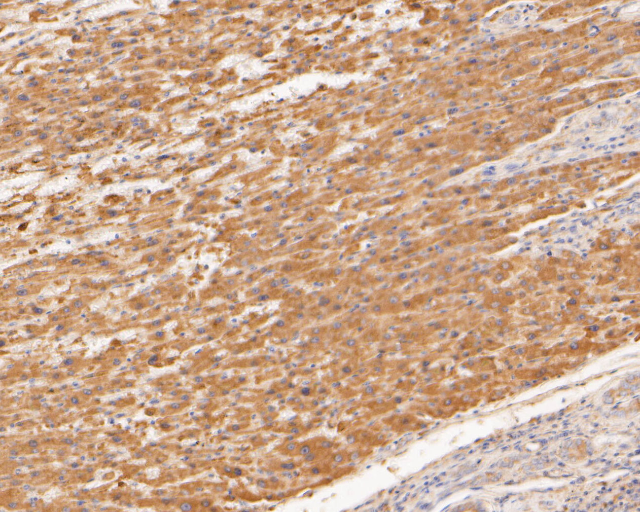 Immunohistochemical analysis of paraffin-embedded human liver tissue using anti-TREM2 antibody. The section was pre-treated using heat mediated antigen retrieval with Tris-EDTA buffer (pH 8.0-8.4) for 20 minutes.The tissues were blocked in 5% BSA for 30 minutes at room temperature, washed with ddH2O and PBS, and then probed with the primary antibody (ER1902-96, 1/50) for 30 minutes at room temperature. The detection was performed using an HRP conjugated compact polymer system. DAB was used as the chromogen. Tissues were counterstained with hematoxylin and mounted with DPX.