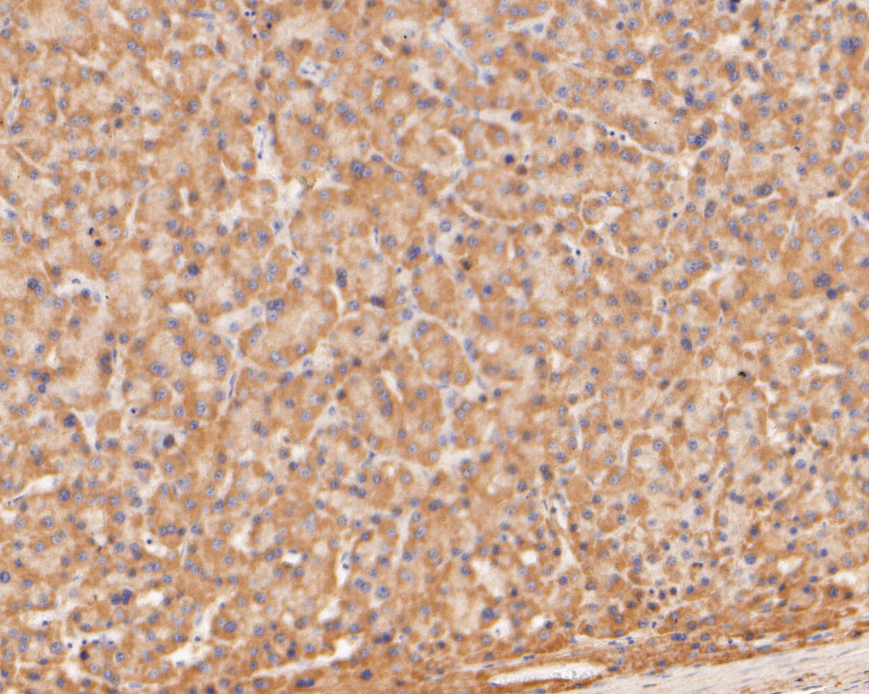 Immunohistochemical analysis of paraffin-embedded human liver carcinoma tissue using anti-TREM2 antibody. The section was pre-treated using heat mediated antigen retrieval with Tris-EDTA buffer (pH 8.0-8.4) for 20 minutes.The tissues were blocked in 5% BSA for 30 minutes at room temperature, washed with ddH2O and PBS, and then probed with the primary antibody (ER1902-96, 1/50) for 30 minutes at room temperature. The detection was performed using an HRP conjugated compact polymer system. DAB was used as the chromogen. Tissues were counterstained with hematoxylin and mounted with DPX.