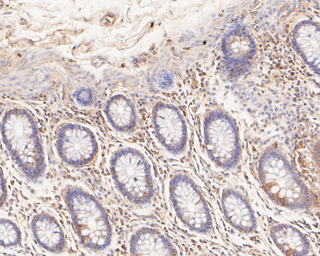 Immunohistochemical analysis of paraffin-embedded human colon carcinoma tissue using anti-TREM2 antibody. The section was pre-treated using heat mediated antigen retrieval with Tris-EDTA buffer (pH 8.0-8.4) for 20 minutes.The tissues were blocked in 5% BSA for 30 minutes at room temperature, washed with ddH2O and PBS, and then probed with the primary antibody (ER1902-96, 1/50) for 30 minutes at room temperature. The detection was performed using an HRP conjugated compact polymer system. DAB was used as the chromogen. Tissues were counterstained with hematoxylin and mounted with DPX.