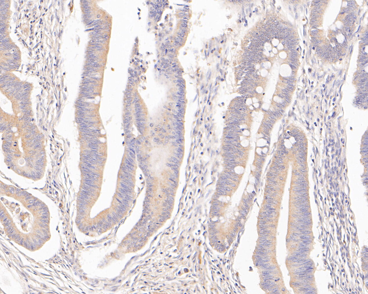 Immunohistochemical analysis of paraffin-embedded human colon carcinoma tissue using anti-MTHFD2 antibody. The section was pre-treated using heat mediated antigen retrieval with Tris-EDTA buffer (pH 8.0-8.4) for 20 minutes.The tissues were blocked in 5% BSA for 30 minutes at room temperature, washed with ddH2O and PBS, and then probed with the primary antibody (ER1902-98, 1/200) for 30 minutes at room temperature. The detection was performed using an HRP conjugated compact polymer system. DAB was used as the chromogen. Tissues were counterstained with hematoxylin and mounted with DPX.