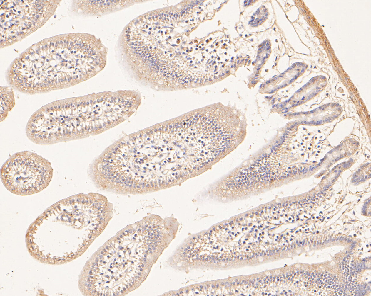 Immunohistochemical analysis of paraffin-embedded human tonsil carcinoma tissue using anti-MTHFD2 antibody. The section was pre-treated using heat mediated antigen retrieval with Tris-EDTA buffer (pH 8.0-8.4) for 20 minutes.The tissues were blocked in 5% BSA for 30 minutes at room temperature, washed with ddH2O and PBS, and then probed with the primary antibody (ER1902-98, 1/50) for 30 minutes at room temperature. The detection was performed using an HRP conjugated compact polymer system. DAB was used as the chromogen. Tissues were counterstained with hematoxylin and mounted with DPX.