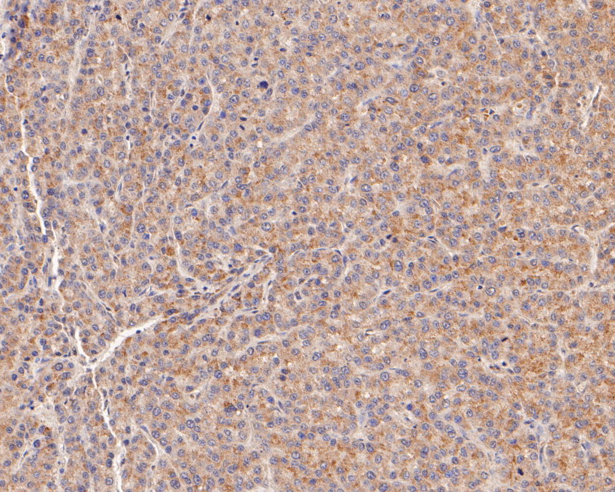 Immunohistochemical analysis of paraffin-embedded human liver carcinoma tissue using anti-MFF antibody. The section was pre-treated using heat mediated antigen retrieval with Tris-EDTA buffer (pH 8.0-8.4) for 20 minutes.The tissues were blocked in 5% BSA for 30 minutes at room temperature, washed with ddH2O and PBS, and then probed with the primary antibody (ER2001-01, 1/200) for 30 minutes at room temperature. The detection was performed using an HRP conjugated compact polymer system. DAB was used as the chromogen. Tissues were counterstained with hematoxylin and mounted with DPX.