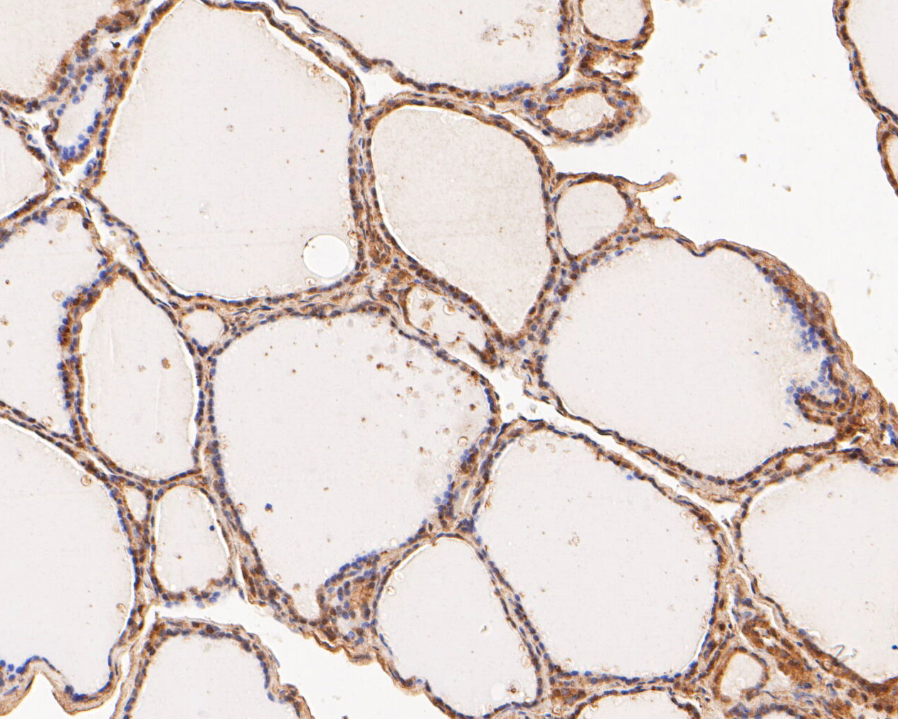 Immunohistochemical analysis of paraffin-embedded human thyroid tissue using anti-FYCO1 antibody. The section was pre-treated using heat mediated antigen retrieval with Tris-EDTA buffer (pH 8.0-8.4) for 20 minutes.The tissues were blocked in 5% BSA for 30 minutes at room temperature, washed with ddH2O and PBS, and then probed with the primary antibody (ER2001-04, 1/500) for 30 minutes at room temperature. The detection was performed using an HRP conjugated compact polymer system. DAB was used as the chromogen. Tissues were counterstained with hematoxylin and mounted with DPX.