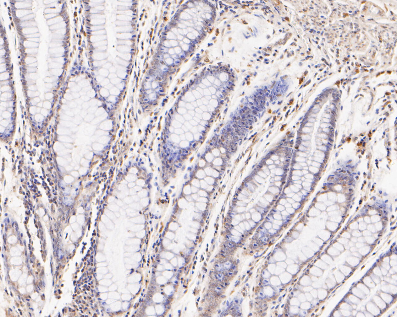 Immunohistochemical analysis of paraffin-embedded human colon tissue using anti-FYCO1 antibody. The section was pre-treated using heat mediated antigen retrieval with Tris-EDTA buffer (pH 8.0-8.4) for 20 minutes.The tissues were blocked in 5% BSA for 30 minutes at room temperature, washed with ddH2O and PBS, and then probed with the primary antibody (ER2001-04, 1/500) for 30 minutes at room temperature. The detection was performed using an HRP conjugated compact polymer system. DAB was used as the chromogen. Tissues were counterstained with hematoxylin and mounted with DPX.