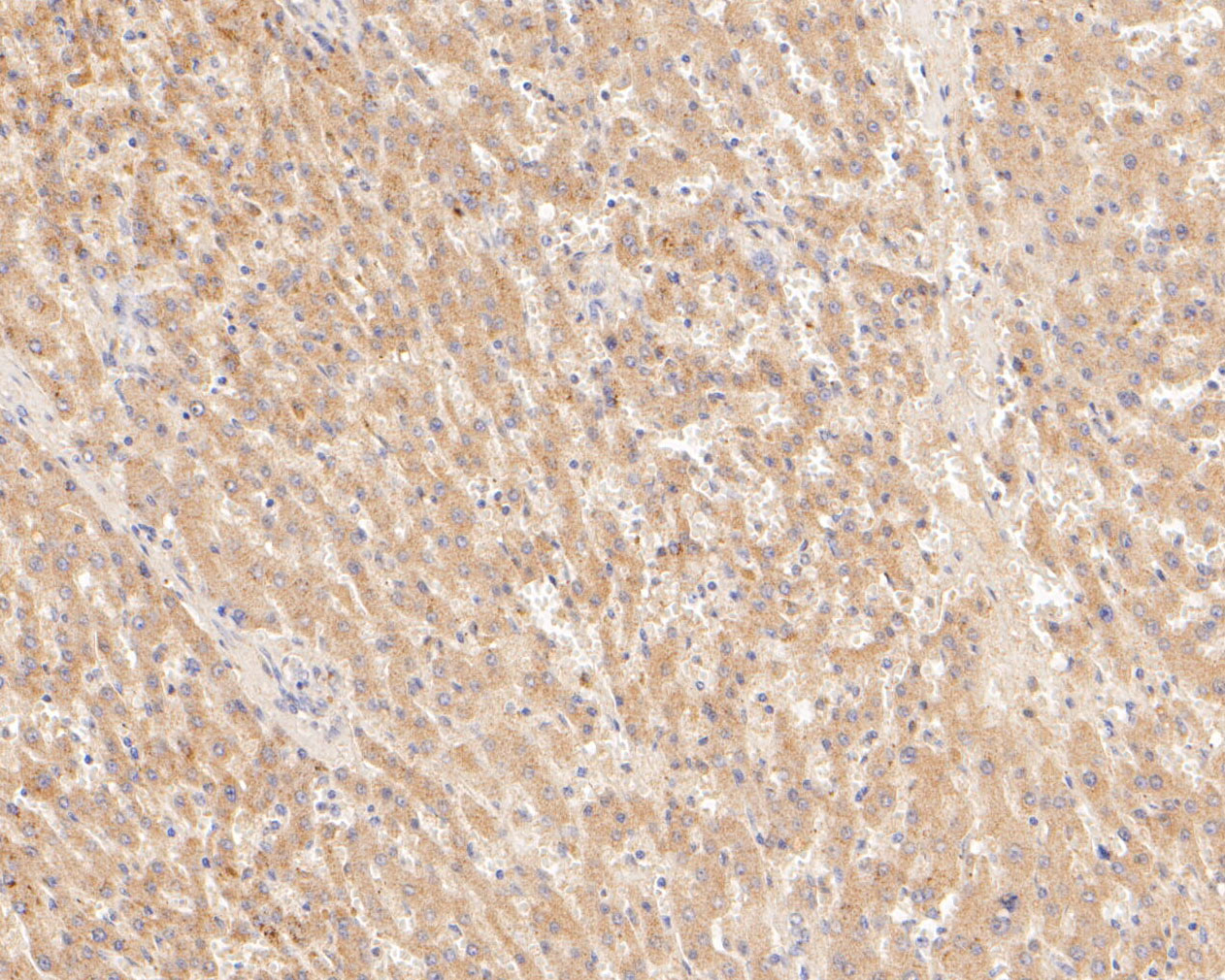 Immunohistochemical analysis of paraffin-embedded human liver tissue using anti-TREM2 antibody. The section was pre-treated using heat mediated antigen retrieval with Tris-EDTA buffer (pH 8.0-8.4) for 20 minutes.The tissues were blocked in 5% BSA for 30 minutes at room temperature, washed with ddH2O and PBS, and then probed with the primary antibody (ER2001-05, 1/200) for 30 minutes at room temperature. The detection was performed using an HRP conjugated compact polymer system. DAB was used as the chromogen. Tissues were counterstained with hematoxylin and mounted with DPX.