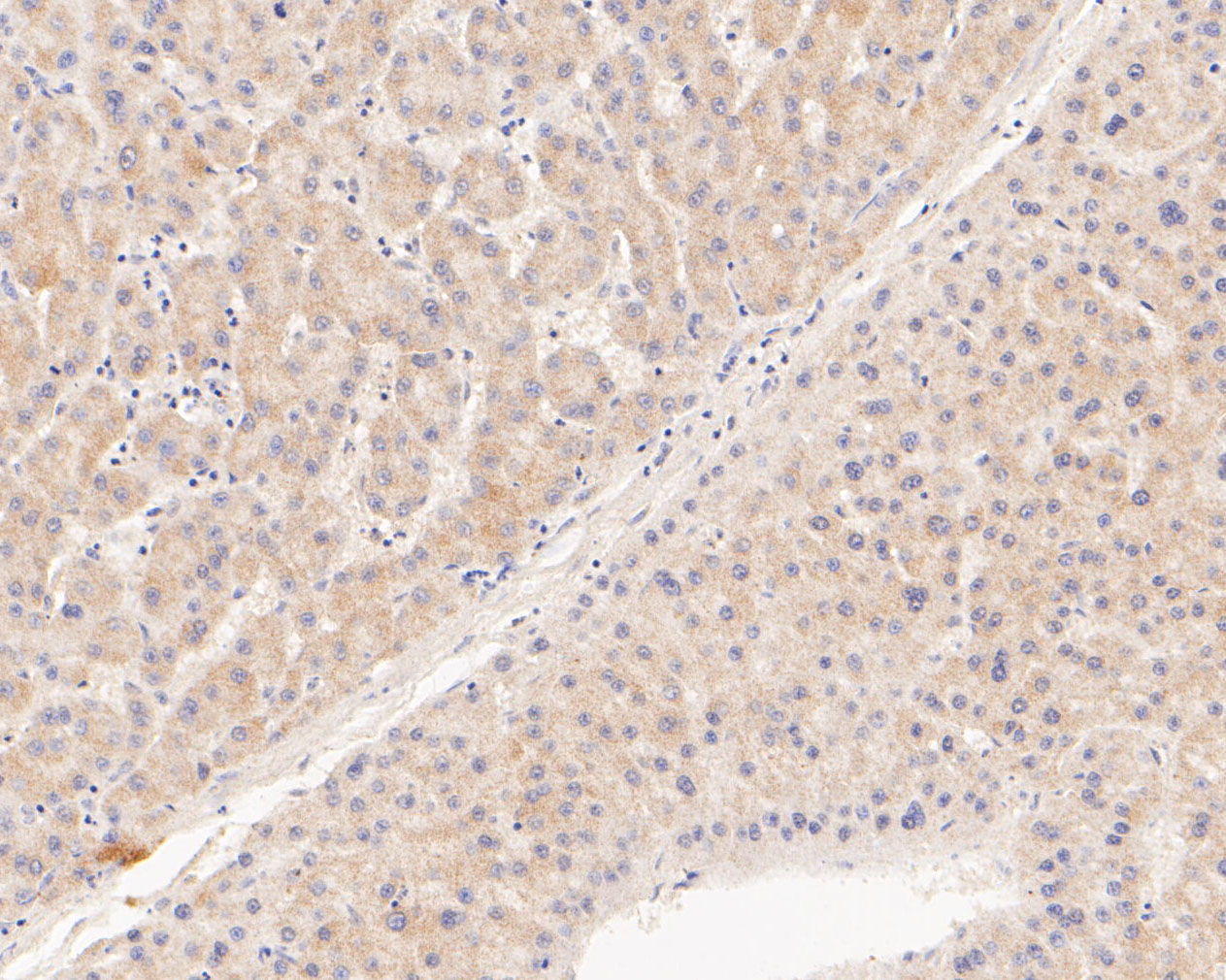 Immunohistochemical analysis of paraffin-embedded human liver carcinoma tissue using anti-TREM2 antibody. The section was pre-treated using heat mediated antigen retrieval with Tris-EDTA buffer (pH 8.0-8.4) for 20 minutes.The tissues were blocked in 5% BSA for 30 minutes at room temperature, washed with ddH2O and PBS, and then probed with the primary antibody (ER2001-05, 1/200) for 30 minutes at room temperature. The detection was performed using an HRP conjugated compact polymer system. DAB was used as the chromogen. Tissues were counterstained with hematoxylin and mounted with DPX.