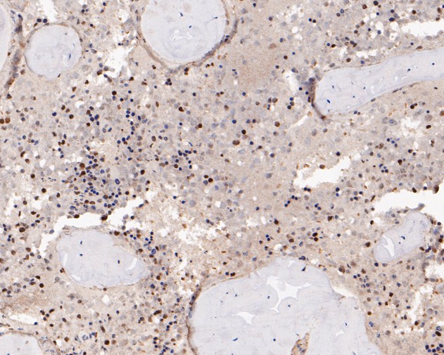 Immunohistochemical analysis of paraffin-embedded human bone marrow tissue using anti-LMO2 antibody. The section was pre-treated using heat mediated antigen retrieval with sodium citrate buffer (pH 6.0) for 20 minutes. The tissues were blocked in 5% BSA for 30 minutes at room temperature, washed with ddH2O and PBS, and then probed with the primary antibody (ER2001-08, 1/200)  for 30 minutes at room temperature. The detection was performed using an HRP conjugated compact polymer system. DAB was used as the chromogen. Tissues were counterstained with hematoxylin and mounted with DPX.