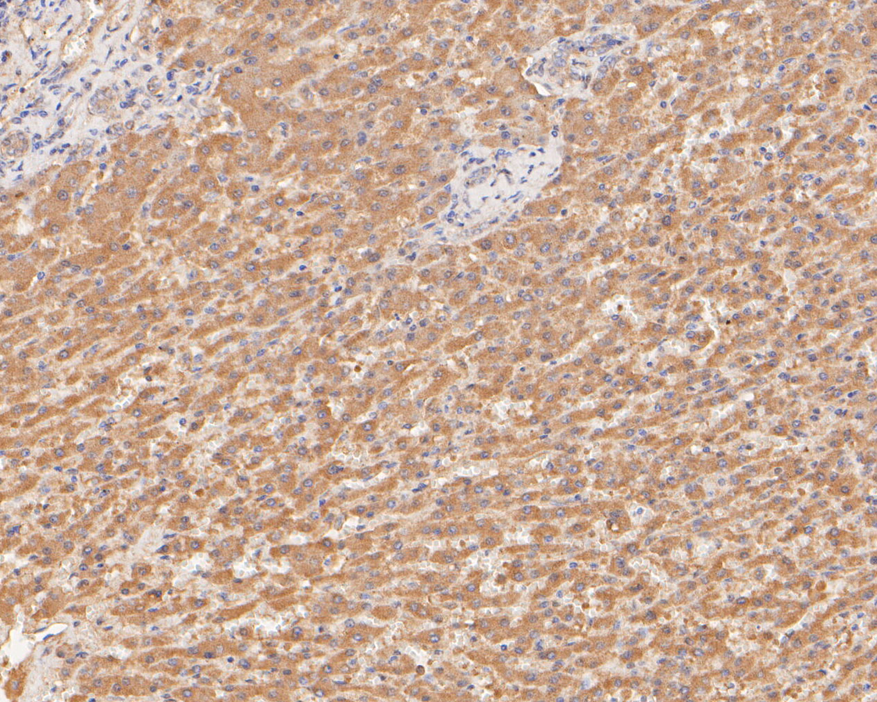 Immunohistochemical analysis of paraffin-embedded human liver tissue using anti-GBP2 antibody. The section was pre-treated using heat mediated antigen retrieval with sodium citrate buffer (pH 6.0) for 20 minutes. The tissues were blocked in 5% BSA for 30 minutes at room temperature, washed with ddH2O and PBS, and then probed with the primary antibody (ER2001-12, 1/100)  for 30 minutes at room temperature. The detection was performed using an HRP conjugated compact polymer system. DAB was used as the chromogen. Tissues were counterstained with hematoxylin and mounted with DPX.
