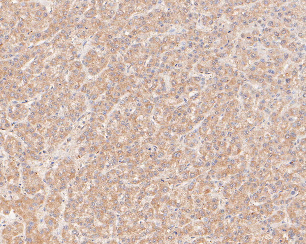 Immunohistochemical analysis of paraffin-embedded human liver carcinoma tissue using anti-GBP2 antibody. The section was pre-treated using heat mediated antigen retrieval with sodium citrate buffer (pH 6.0) for 20 minutes. The tissues were blocked in 5% BSA for 30 minutes at room temperature, washed with ddH2O and PBS, and then probed with the primary antibody (ER2001-12, 1/100)  for 30 minutes at room temperature. The detection was performed using an HRP conjugated compact polymer system. DAB was used as the chromogen. Tissues were counterstained with hematoxylin and mounted with DPX.