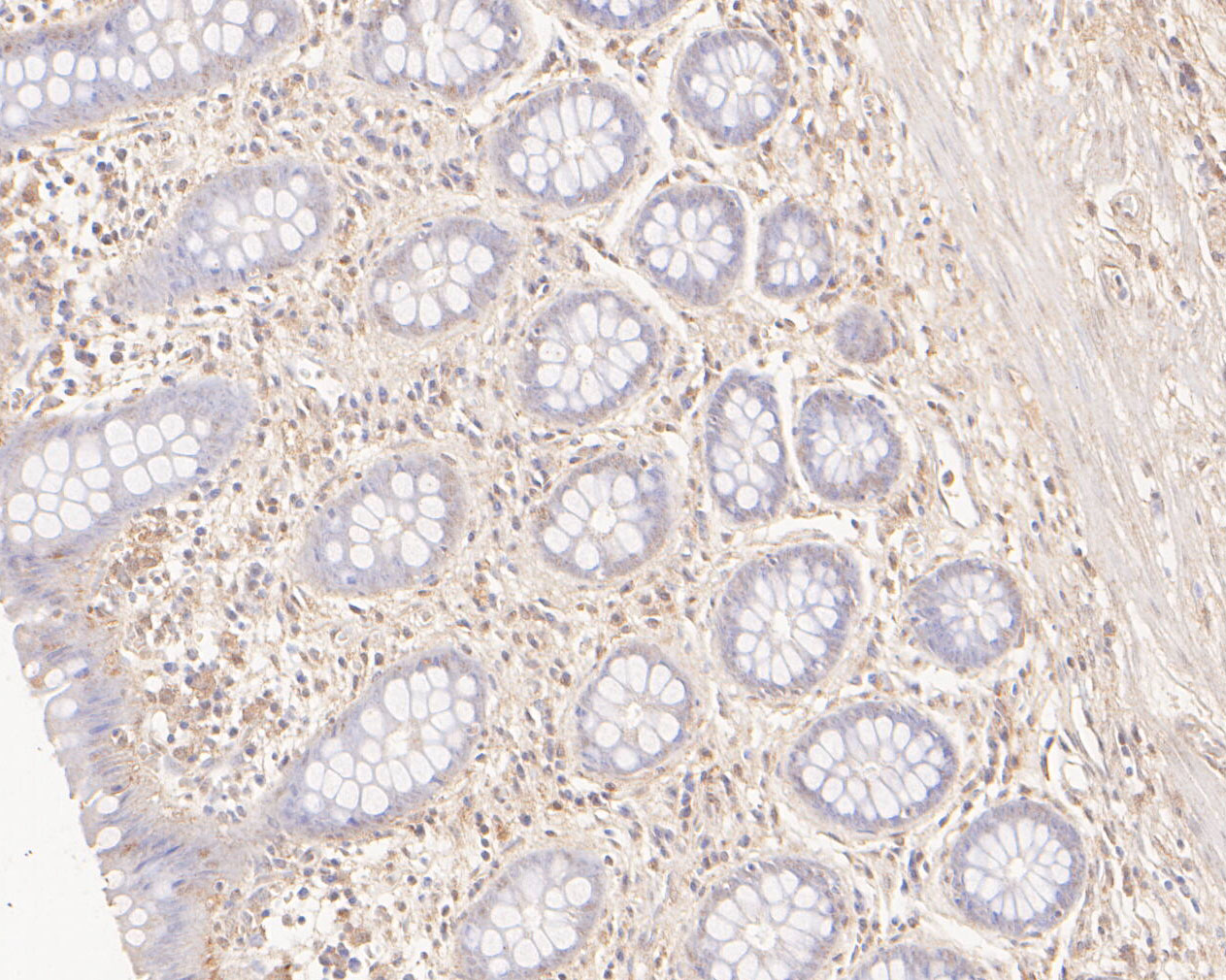 Immunohistochemical analysis of paraffin-embedded human colon tissue using anti-GBP2 antibody. The section was pre-treated using heat mediated antigen retrieval with sodium citrate buffer (pH 6.0) for 20 minutes. The tissues were blocked in 5% BSA for 30 minutes at room temperature, washed with ddH2O and PBS, and then probed with the primary antibody (ER2001-12, 1/100)  for 30 minutes at room temperature. The detection was performed using an HRP conjugated compact polymer system. DAB was used as the chromogen. Tissues were counterstained with hematoxylin and mounted with DPX.