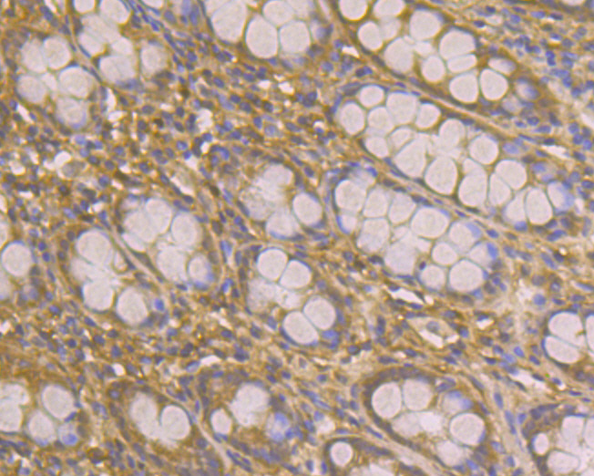Immunohistochemical analysis of paraffin-embedded human colon tissue using anti-IRS1 antibody. The section was pre-treated using heat mediated antigen retrieval with Tris-EDTA buffer (pH 8.0-8.4) for 20 minutes.The tissues were blocked in 5% BSA for 30 minutes at room temperature, washed with ddH2O and PBS, and then probed with the primary antibody (ER2001-35, 1/50) for 30 minutes at room temperature. The detection was performed using an HRP conjugated compact polymer system. DAB was used as the chromogen. Tissues were counterstained with hematoxylin and mounted with DPX.