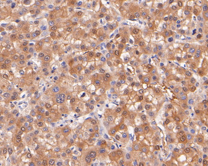 Immunohistochemical analysis of paraffin-embedded human liver carcinoma tissue using anti-CBR1 antibody. The section was pre-treated using heat mediated antigen retrieval with Tris-EDTA buffer (pH 8.0-8.4) for 20 minutes.The tissues were blocked in 5% BSA for 30 minutes at room temperature, washed with ddH2O and PBS, and then probed with the primary antibody (ER2001-45, 1/800) for 30 minutes at room temperature. The detection was performed using an HRP conjugated compact polymer system. DAB was used as the chromogen. Tissues were counterstained with hematoxylin and mounted with DPX.
