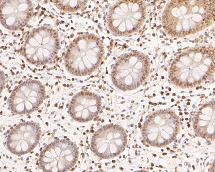 Immunohistochemical analysis of paraffin-embedded human colon tissue using anti-eIF-6 antibody. The section was pre-treated using heat mediated antigen retrieval with sodium citrate buffer (pH 6.0) for 20 minutes. The tissues were blocked in 5% BSA for 30 minutes at room temperature, washed with ddH2O and PBS, and then probed with the primary antibody (ER2001-54, 1/2,000)  for 30 minutes at room temperature. The detection was performed using an HRP conjugated compact polymer system. DAB was used as the chromogen. Tissues were counterstained with hematoxylin and mounted with DPX.