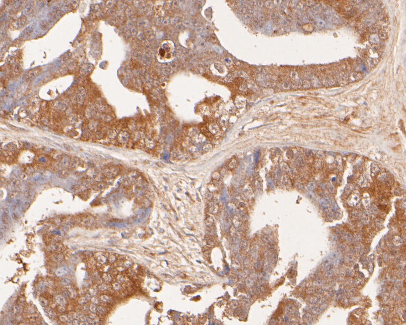 Immunohistochemical analysis of paraffin-embedded human prostate carcinoma tissue using anti-GADD34 antibody. The section was pre-treated using heat mediated antigen retrieval with Tris-EDTA buffer (pH 8.0-8.4) for 20 minutes.The tissues were blocked in 5% BSA for 30 minutes at room temperature, washed with ddH2O and PBS, and then probed with the primary antibody (ER2001-56, 1/50) for 30 minutes at room temperature. The detection was performed using an HRP conjugated compact polymer system. DAB was used as the chromogen. Tissues were counterstained with hematoxylin and mounted with DPX.