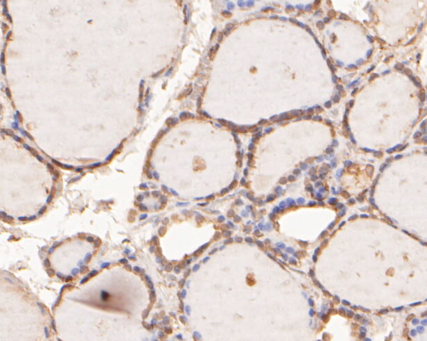 Immunohistochemical analysis of paraffin-embedded human thyroid tissue using anti-hNaa50p antibody. The section was pre-treated using heat mediated antigen retrieval with sodium citrate buffer (pH 6.0) for 20 minutes. The tissues were blocked in 5% BSA for 30 minutes at room temperature, washed with ddH2O and PBS, and then probed with the primary antibody (ER2001-66, 1/500)  for 30 minutes at room temperature. The detection was performed using an HRP conjugated compact polymer system. DAB was used as the chromogen. Tissues were counterstained with hematoxylin and mounted with DPX.
