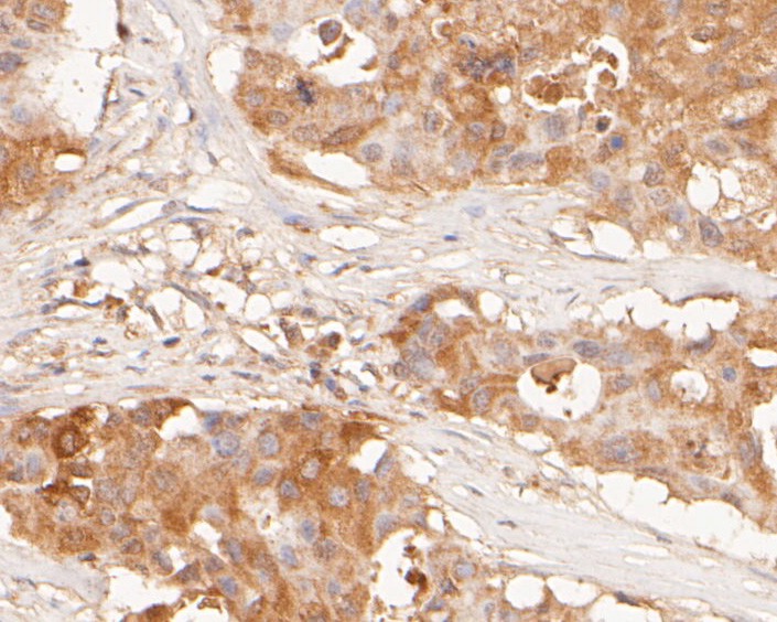 Immunohistochemical analysis of paraffin-embedded human breast carcinoma tissue using anti-hNaa50p antibody. The section was pre-treated using heat mediated antigen retrieval with sodium citrate buffer (pH 6.0) for 20 minutes. The tissues were blocked in 5% BSA for 30 minutes at room temperature, washed with ddH2O and PBS, and then probed with the primary antibody (ER2001-66, 1/50)  for 30 minutes at room temperature. The detection was performed using an HRP conjugated compact polymer system. DAB was used as the chromogen. Tissues were counterstained with hematoxylin and mounted with DPX.