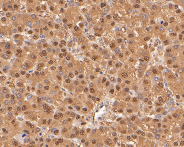 Immunohistochemical analysis of paraffin-embedded human liver carcinoma tissue using anti-PSMA5 antibody. The section was pre-treated using heat mediated antigen retrieval with sodium citrate buffer (pH 6.0) for 20 minutes. The tissues were blocked in 5% BSA for 30 minutes at room temperature, washed with ddH2O and PBS, and then probed with the primary antibody (ER2001-68, 1/400)  for 30 minutes at room temperature. The detection was performed using an HRP conjugated compact polymer system. DAB was used as the chromogen. Tissues were counterstained with hematoxylin and mounted with DPX.