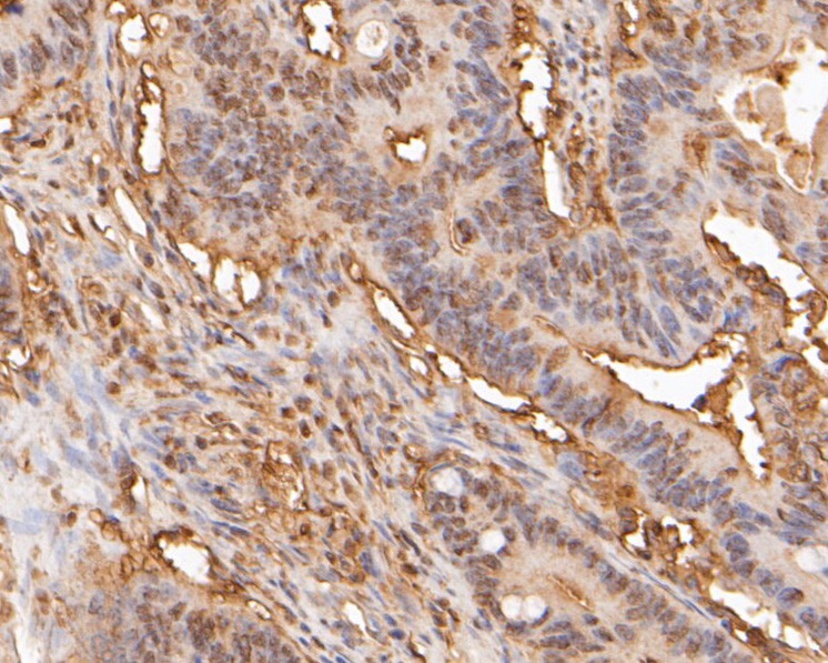Immunohistochemical analysis of paraffin-embedded human colon carcinoma tissue using anti-PSMA5 antibody. The section was pre-treated using heat mediated antigen retrieval with sodium citrate buffer (pH 6.0) for 20 minutes. The tissues were blocked in 5% BSA for 30 minutes at room temperature, washed with ddH2O and PBS, and then probed with the primary antibody (ER2001-68, 1/400)  for 30 minutes at room temperature. The detection was performed using an HRP conjugated compact polymer system. DAB was used as the chromogen. Tissues were counterstained with hematoxylin and mounted with DPX.