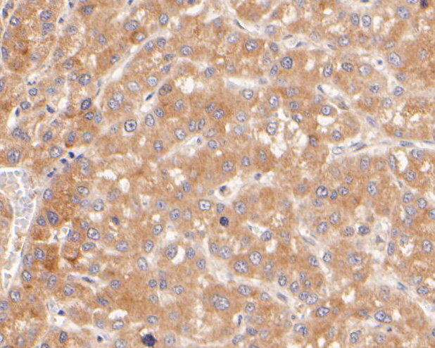 Immunohistochemical analysis of paraffin-embedded human liver carcinoma tissue using anti-SerpinA6 antibody. The section was pre-treated using heat mediated antigen retrieval with Tris-EDTA buffer (pH 8.0-8.4) for 20 minutes.The tissues were blocked in 5% BSA for 30 minutes at room temperature, washed with ddH2O and PBS, and then probed with the primary antibody (ER2001-70, 1/400) for 30 minutes at room temperature. The detection was performed using an HRP conjugated compact polymer system. DAB was used as the chromogen. Tissues were counterstained with hematoxylin and mounted with DPX.