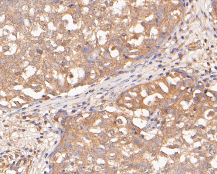 Immunohistochemical analysis of paraffin-embedded human breast carcinoma tissue using anti-SerpinA6 antibody. The section was pre-treated using heat mediated antigen retrieval with Tris-EDTA buffer (pH 8.0-8.4) for 20 minutes.The tissues were blocked in 5% BSA for 30 minutes at room temperature, washed with ddH2O and PBS, and then probed with the primary antibody (ER2001-70, 1/400) for 30 minutes at room temperature. The detection was performed using an HRP conjugated compact polymer system. DAB was used as the chromogen. Tissues were counterstained with hematoxylin and mounted with DPX.