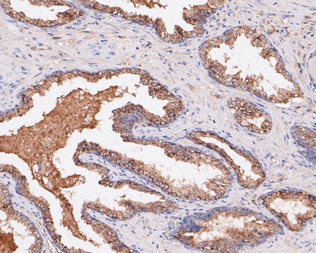 Immunohistochemical analysis of paraffin-embedded human prostate carcinoma tissue with Rabbit anti-PLAP antibody (ET7111-06) at 1/50 dilution.<br />
<br />
The section was pre-treated using heat mediated antigen retrieval with sodium citrate buffer (pH 6.0) for 2 minutes. The tissues were blocked in 1% BSA for 20 minutes at room temperature, washed with ddH2O and PBS, and then probed with the primary antibody (ET7111-06) at 1/50 dilution for 1 hour at room temperature. The detection was performed using an HRP conjugated compact polymer system. DAB was used as the chromogen. Tissues were counterstained with hematoxylin and mounted with DPX.