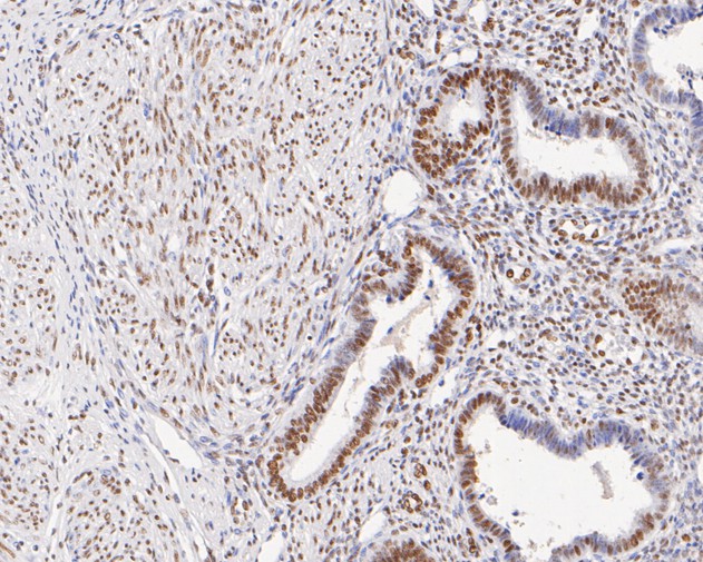 Immunohistochemical analysis of paraffin-embedded human uterus tissue with Rabbit anti-GTF2F2 antibody (ET7111-08) at 1/50 dilution.<br />
<br />
The section was pre-treated using heat mediated antigen retrieval with sodium citrate buffer (pH 6.0) for 2 minutes. The tissues were blocked in 1% BSA for 20 minutes at room temperature, washed with ddH2O and PBS, and then probed with the primary antibody (ET7111-08) at 1/50 dilution for 1 hour at room temperature. The detection was performed using an HRP conjugated compact polymer system. DAB was used as the chromogen. Tissues were counterstained with hematoxylin and mounted with DPX.