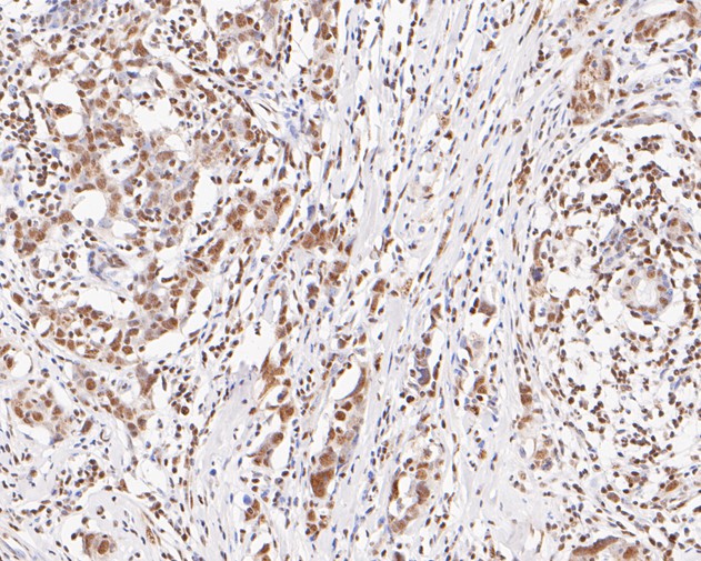 Immunohistochemical analysis of paraffin-embedded human breast carcinoma tissue using anti-Ube2B antibody. The section was pre-treated using heat mediated antigen retrieval with sodium citrate buffer (pH 6.0) for 20 minutes. The tissues were blocked in 5% BSA for 30 minutes at room temperature, washed with ddH2O and PBS, and then probed with the primary antibody (ET7111-09, 1/200)  for 30 minutes at room temperature. The detection was performed using an HRP conjugated compact polymer system. DAB was used as the chromogen. Tissues were counterstained with hematoxylin and mounted with DPX.