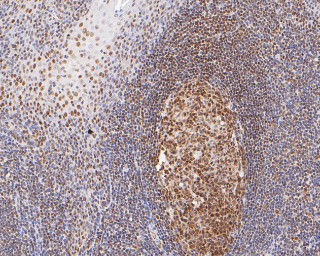 Immunohistochemical analysis of paraffin-embedded human tonsil tissue with Rabbit anti-TFII I antibody (ET7111-10) at 1/200 dilution.<br />
<br />
The section was pre-treated using heat mediated antigen retrieval with sodium citrate buffer (pH 6.0) for 2 minutes. The tissues were blocked in 1% BSA for 20 minutes at room temperature, washed with ddH2O and PBS, and then probed with the primary antibody (ET7111-10) at 1/200 dilution for 1 hour at room temperature. The detection was performed using an HRP conjugated compact polymer system. DAB was used as the chromogen. Tissues were counterstained with hematoxylin and mounted with DPX.