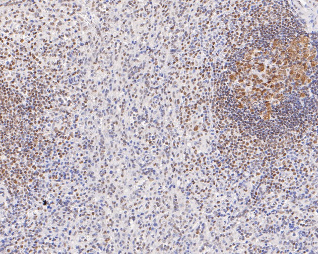Immunohistochemical analysis of paraffin-embedded human spleen tissue with Rabbit anti-TFII I antibody (ET7111-10) at 1/200 dilution.<br />
<br />
The section was pre-treated using heat mediated antigen retrieval with sodium citrate buffer (pH 6.0) for 2 minutes. The tissues were blocked in 1% BSA for 20 minutes at room temperature, washed with ddH2O and PBS, and then probed with the primary antibody (ET7111-10) at 1/200 dilution for 1 hour at room temperature. The detection was performed using an HRP conjugated compact polymer system. DAB was used as the chromogen. Tissues were counterstained with hematoxylin and mounted with DPX.