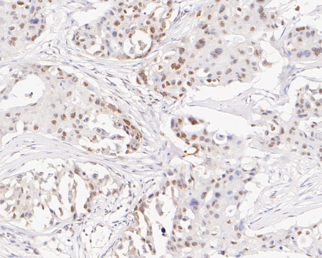 Immunohistochemical analysis of paraffin-embedded human breast carcinoma tissue with Rabbit anti-TFII I antibody (ET7111-10) at 1/200 dilution.<br />
<br />
The section was pre-treated using heat mediated antigen retrieval with sodium citrate buffer (pH 6.0) for 2 minutes. The tissues were blocked in 1% BSA for 20 minutes at room temperature, washed with ddH2O and PBS, and then probed with the primary antibody (ET7111-10) at 1/200 dilution for 1 hour at room temperature. The detection was performed using an HRP conjugated compact polymer system. DAB was used as the chromogen. Tissues were counterstained with hematoxylin and mounted with DPX.