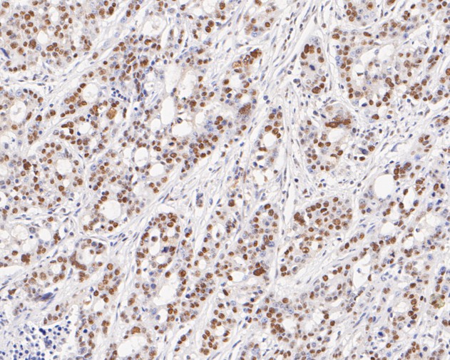 Immunohistochemical analysis of paraffin-embedded human stomach carcinoma tissue with Rabbit anti-TFII I antibody (ET7111-10) at 1/200 dilution.<br />
<br />
The section was pre-treated using heat mediated antigen retrieval with sodium citrate buffer (pH 6.0) for 2 minutes. The tissues were blocked in 1% BSA for 20 minutes at room temperature, washed with ddH2O and PBS, and then probed with the primary antibody (ET7111-10) at 1/200 dilution for 1 hour at room temperature. The detection was performed using an HRP conjugated compact polymer system. DAB was used as the chromogen. Tissues were counterstained with hematoxylin and mounted with DPX.
