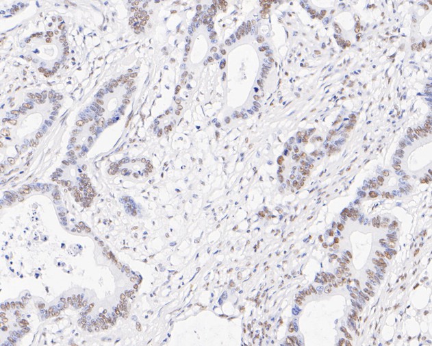 Immunohistochemical analysis of paraffin-embedded human colon carcinoma tissue using anti-RRP42 antibody. The section was pre-treated using heat mediated antigen retrieval with sodium citrate buffer (pH 6.0) for 20 minutes. The tissues were blocked in 5% BSA for 30 minutes at room temperature, washed with ddH2O and PBS, and then probed with the primary antibody (ET7111-13, 1/50)  for 30 minutes at room temperature. The detection was performed using an HRP conjugated compact polymer system. DAB was used as the chromogen. Tissues were counterstained with hematoxylin and mounted with DPX.