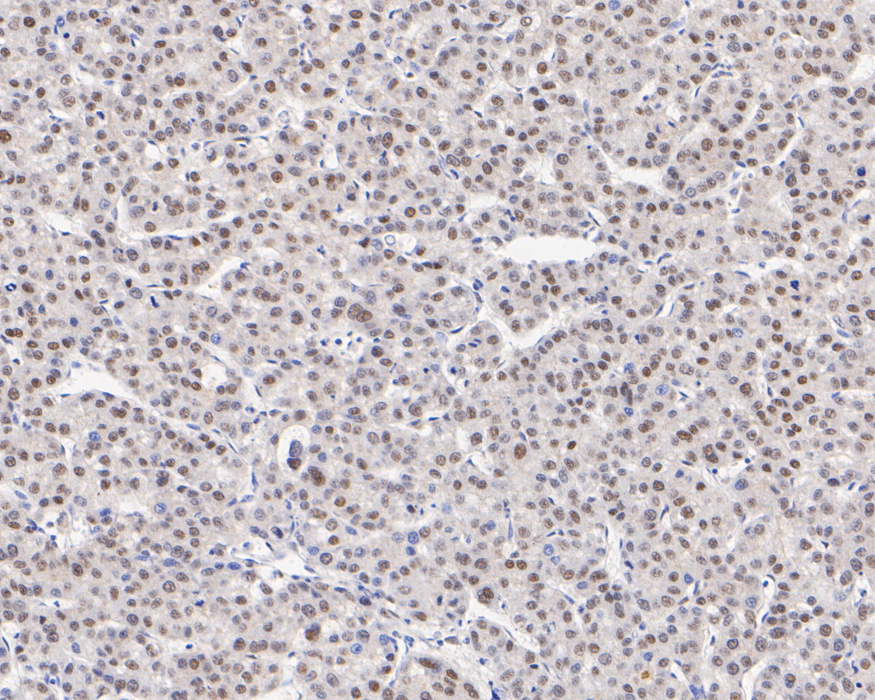Immunohistochemical analysis of paraffin-embedded human liver carcinoma tissue using anti-HTF9C antibody. The section was pre-treated using heat mediated antigen retrieval with sodium citrate buffer (pH 6.0) for 20 minutes. The tissues were blocked in 5% BSA for 30 minutes at room temperature, washed with ddH2O and PBS, and then probed with the primary antibody (ET7111-14, 1/100)  for 30 minutes at room temperature. The detection was performed using an HRP conjugated compact polymer system. DAB was used as the chromogen. Tissues were counterstained with hematoxylin and mounted with DPX.