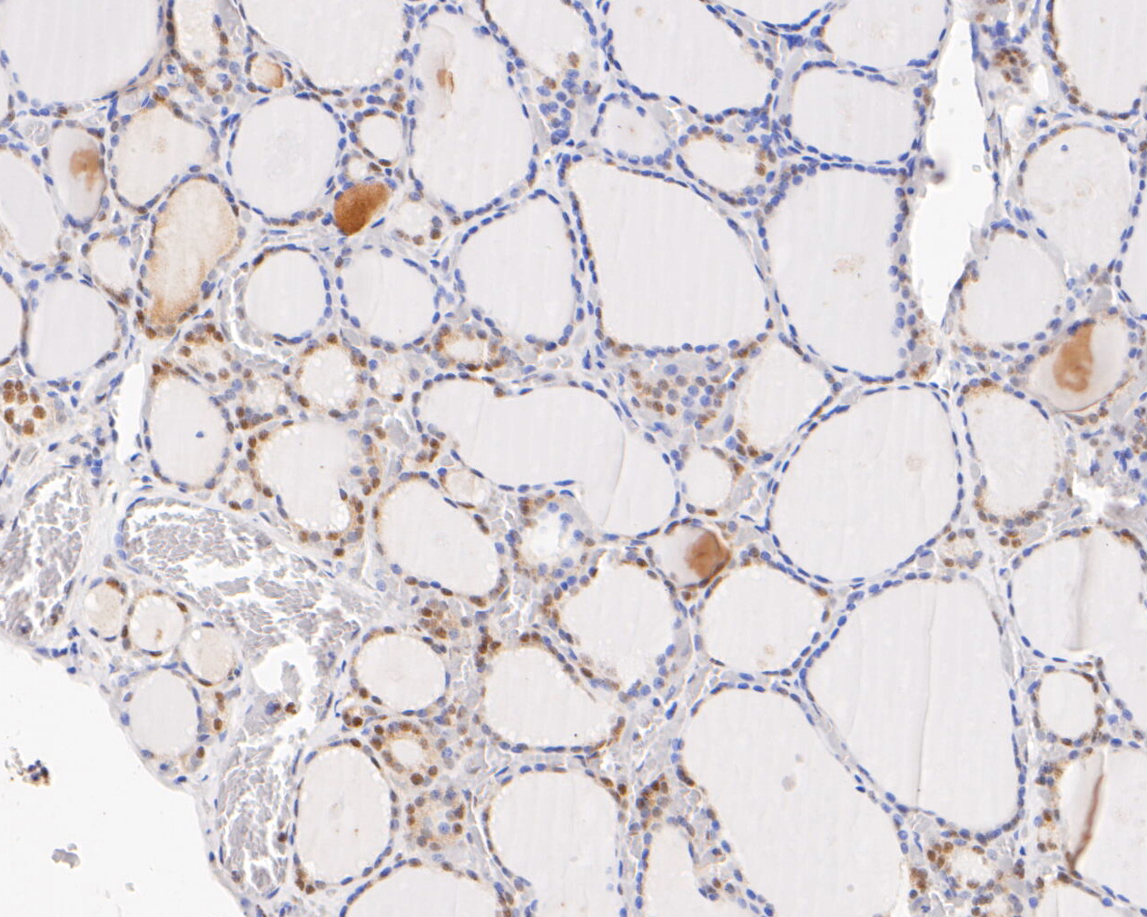 Immunohistochemical analysis of paraffin-embedded human thyroid tissue using anti-HTF9C antibody. The section was pre-treated using heat mediated antigen retrieval with sodium citrate buffer (pH 6.0) for 20 minutes. The tissues were blocked in 5% BSA for 30 minutes at room temperature, washed with ddH2O and PBS, and then probed with the primary antibody (ET7111-14, 1/50)  for 30 minutes at room temperature. The detection was performed using an HRP conjugated compact polymer system. DAB was used as the chromogen. Tissues were counterstained with hematoxylin and mounted with DPX.