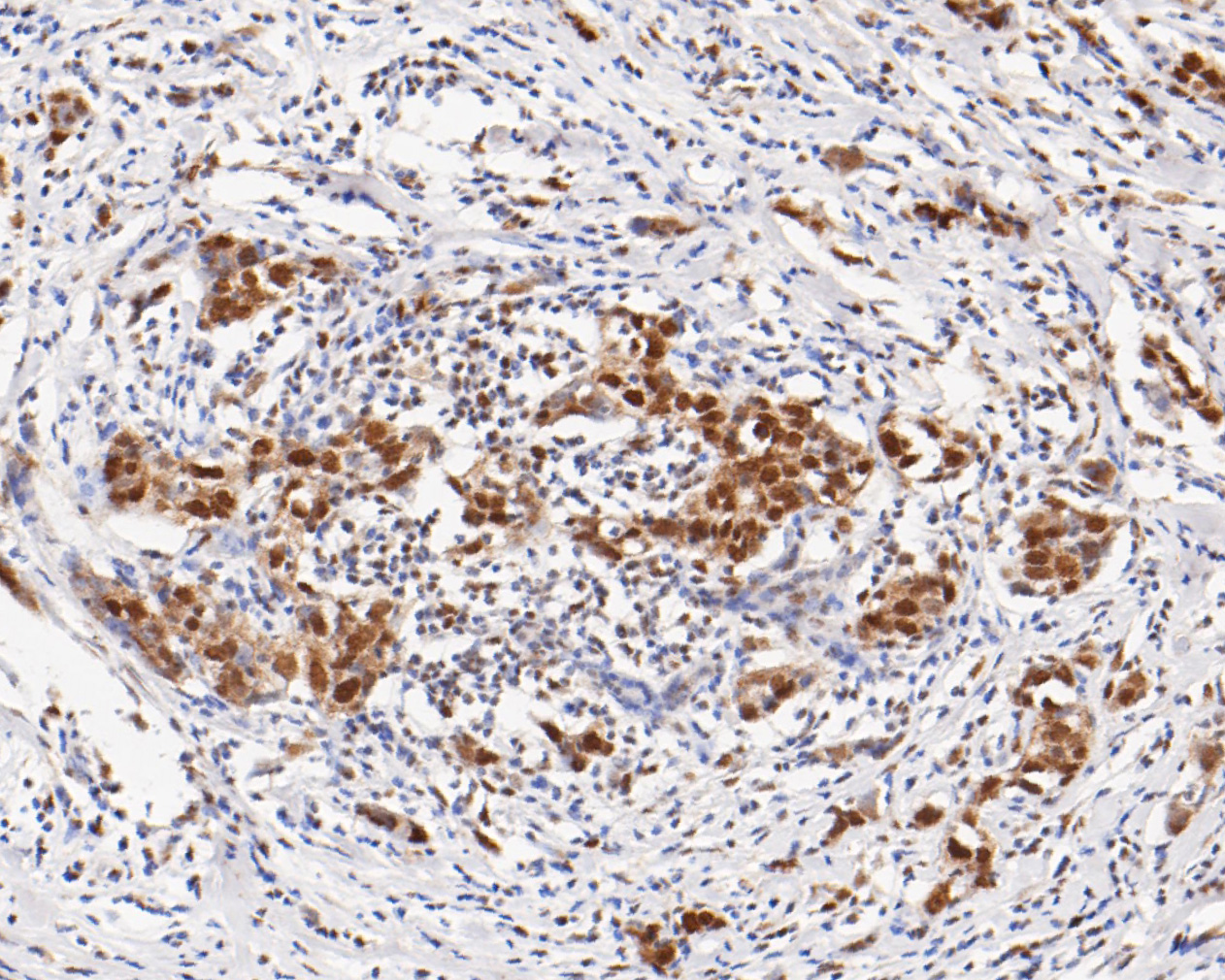 Immunohistochemical analysis of paraffin-embedded human breast carcinoma tissue using anti-HTF9C antibody. The section was pre-treated using heat mediated antigen retrieval with sodium citrate buffer (pH 6.0) for 20 minutes. The tissues were blocked in 5% BSA for 30 minutes at room temperature, washed with ddH2O and PBS, and then probed with the primary antibody (ET7111-14, 1/100)  for 30 minutes at room temperature. The detection was performed using an HRP conjugated compact polymer system. DAB was used as the chromogen. Tissues were counterstained with hematoxylin and mounted with DPX.