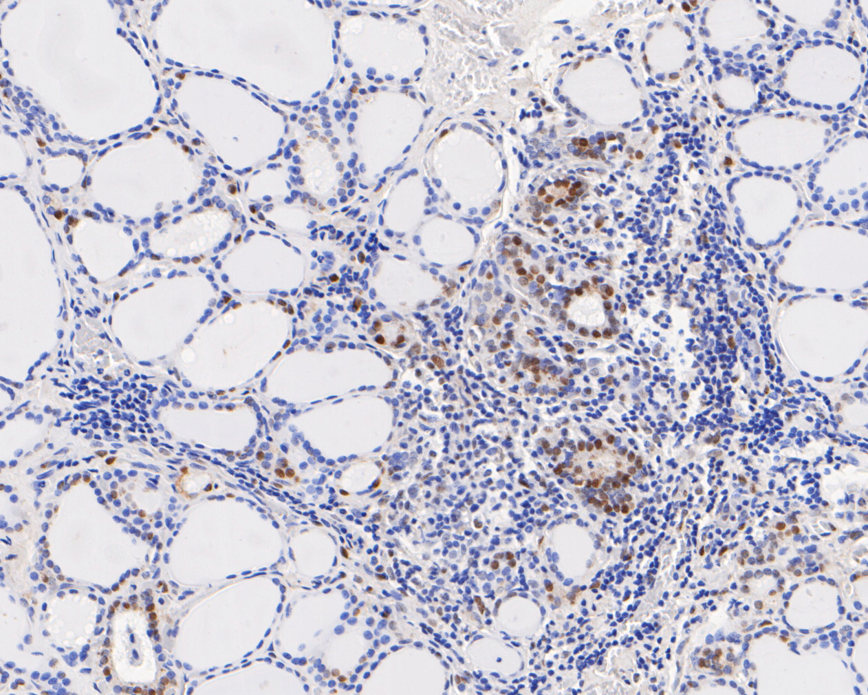 Immunohistochemical analysis of paraffin-embedded human thyroid tissue using anti-CIRP antibody. The section was pre-treated using heat mediated antigen retrieval with sodium citrate buffer (pH 6.0) for 20 minutes. The tissues were blocked in 5% BSA for 30 minutes at room temperature, washed with ddH2O and PBS, and then probed with the primary antibody (ET7111-15, 1/200)  for 30 minutes at room temperature. The detection was performed using an HRP conjugated compact polymer system. DAB was used as the chromogen. Tissues were counterstained with hematoxylin and mounted with DPX.
